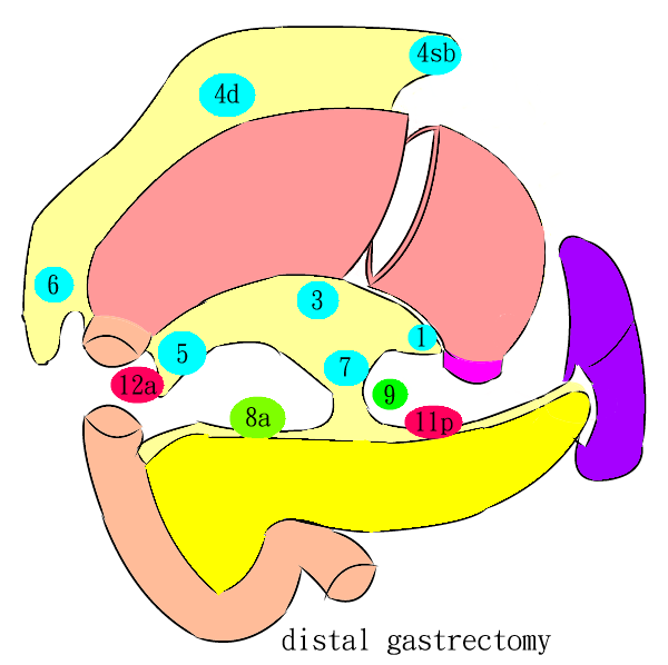 distal gastrectomy (LN)